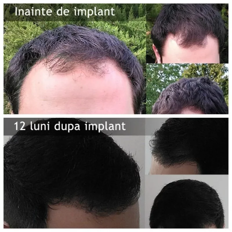 Dr. Felix Hair Implant - Implant de par, sprancene si barba